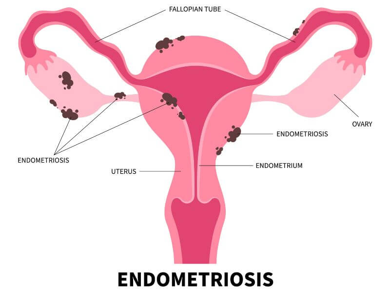 PCOS vs Endometriosis
