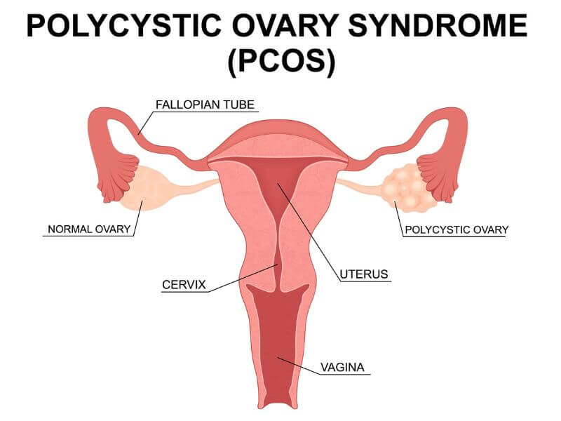PCOS vs Endometriosis