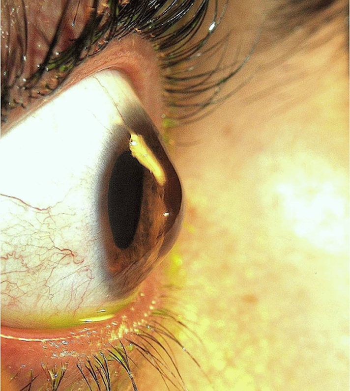 Keratoconus Eye Diagram
