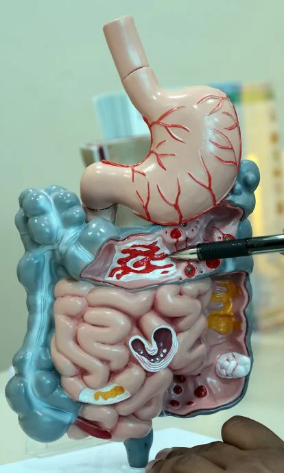 Colon cancer mainly develops from polyps, which are growths on the inner wall of the intestine.